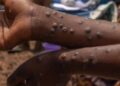 Detectados casos de Mpox no distrito de Lago no Niassa