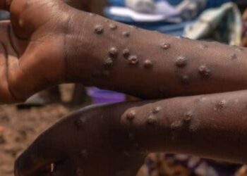 Detectados casos de Mpox no distrito de Lago no Niassa