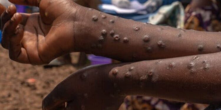 Detectados casos de Mpox no distrito de Lago no Niassa