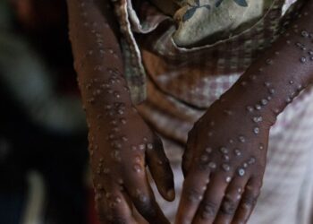 Governo garante estar a trabalhar para travar o alastramento da Mpox em Moçambique