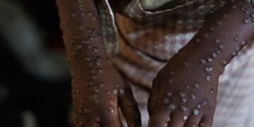 Governo garante estar a trabalhar para travar o alastramento da Mpox em Moçambique