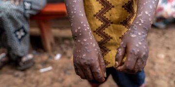 Doença Mpox chega ao sul de Moçambique com primeiro caso confirmado na Província de Maputo